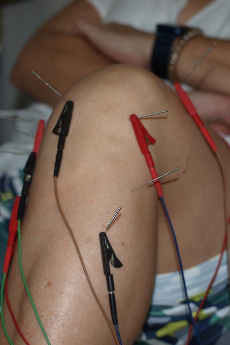 Electroacupuntura medicina china Lebrija