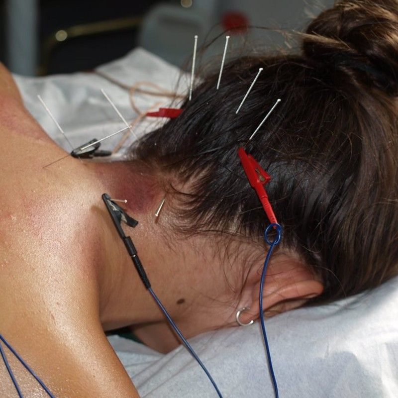 Electroacupuntura
